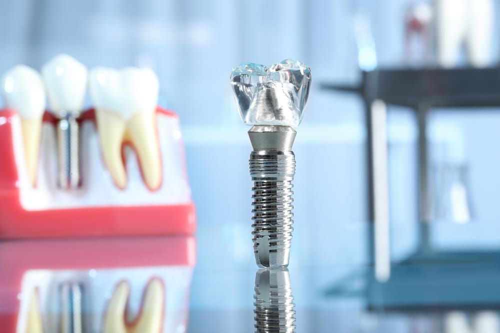 Dental Implants