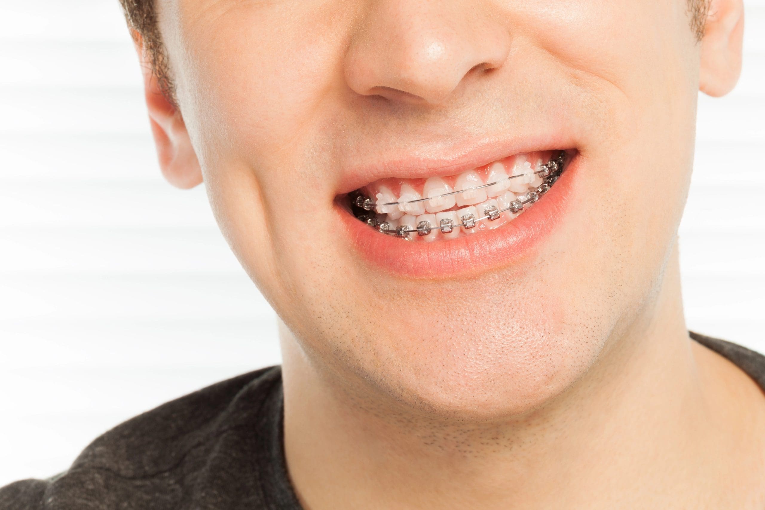 Traditional Mukwonago Braces: Benefits And Expectations